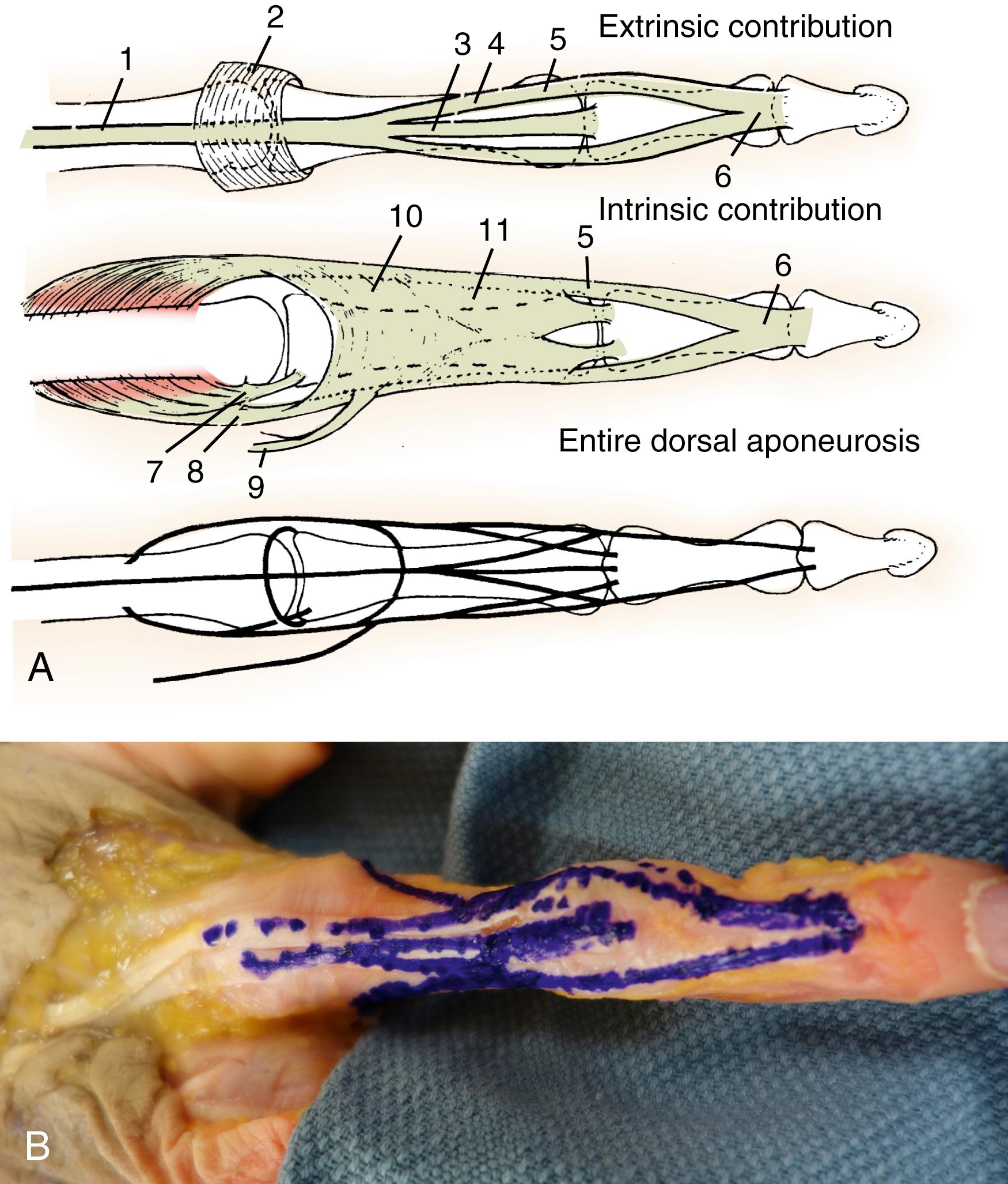 Fig. 10.7, Dorsal view of the dorsal aponeurosis of the finger. A, Diagrammatic representation of the extrinsic and intrinsic contributions of the dorsal aponeurosis. 1, Extensor tendon; 2, sagittal band; 3, central slip; 4, lateral slip; 5, conjoined lateral band; 6, terminal tendon; 7, superficial head and medial tendon of the dorsal interosseous; 8, deep head and lateral tendon of the dorsal interosseous; 9, lumbrical muscle and tendon; 10, transverse fibers of the dorsal aponeurosis; 11, oblique fibers of the dorsal aponeurosis. B, Dissected specimen showing the dorsal aponeurosis of the finger. The central slip, lateral slips, lateral band, and conjoined lateral band are identified by solid lines over the proximal phalanx. The conjoined lateral bands and terminal tendons are identified by continuous lines over the middle phalanx. The dotted lines represent the transverse fibers (proximally) and oblique fibers (distally) of the dorsal aponeurosis overlying the proximal phalanx.