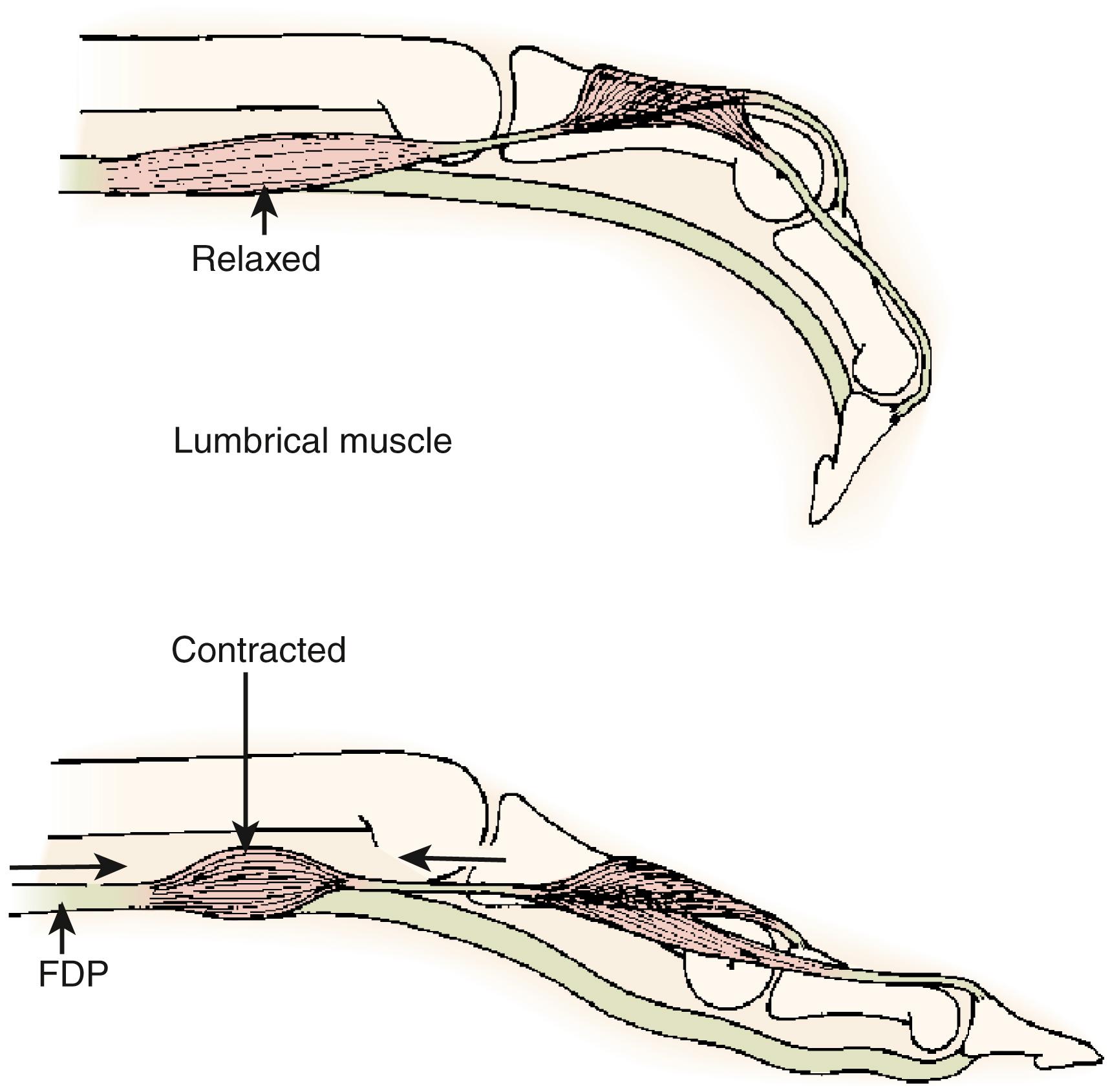 Fig. 10.8, The lumbrical muscle arises from the flexor digitorum profundus (FDP) tendon. When the lumbrical is relaxed and the FDP contracts, the interphalangeal joints flex. When the lumbrical contracts, it extends the interphalangeal joints both through relaxation of the profundus tendon distal to the lumbrical origin and through proximal pull on the lateral band and dorsal aponeurosis.