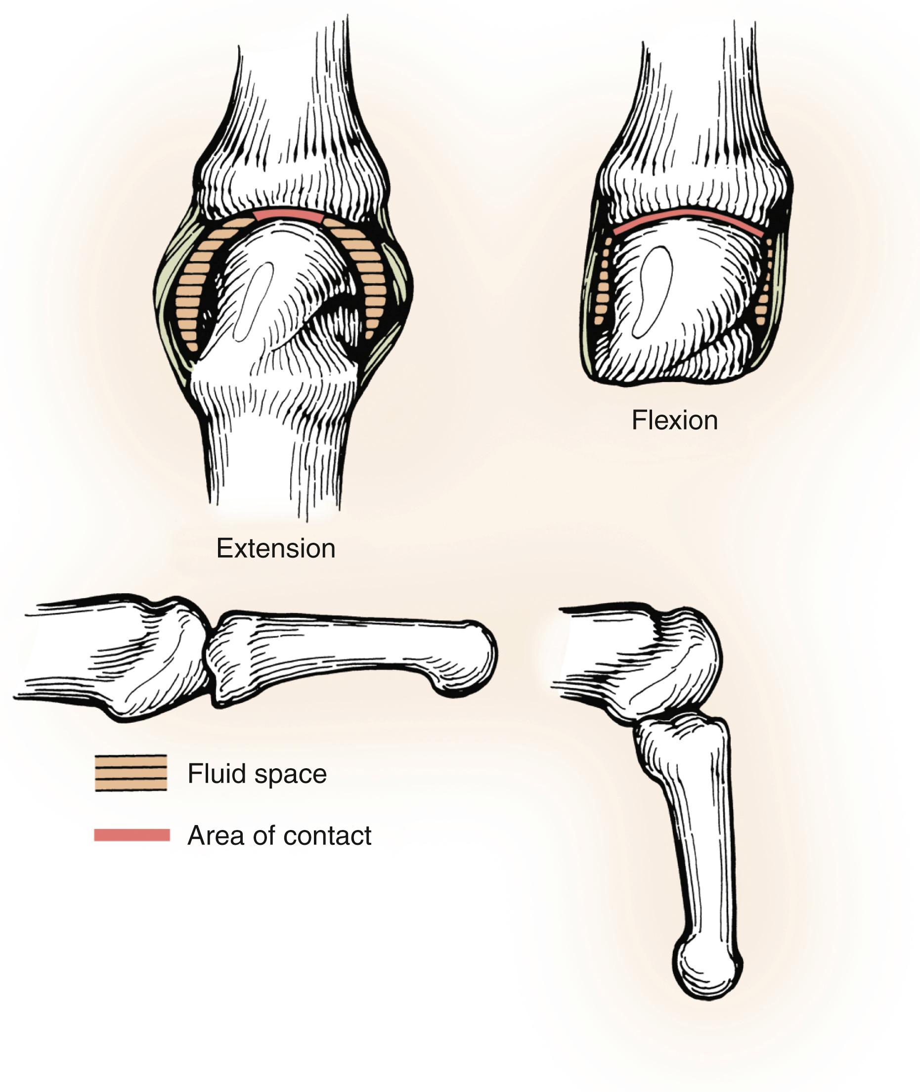 Fig. 10.10, The anatomy of the extended metacarpophalangeal (MP) joint differs from that of the fully flexed MP joint. In extension, the bone contact surface area is minimal. The collateral ligaments are loose, intracapsular fluid space is at a maximum, and the joint is relatively unstable. The proximal phalanx rotates, abducts, and adducts on the metacarpal. In full flexion, the metacarpal condylar surface is broad, and the contact area is maximal between the metacarpal and proximal phalanx. The collateral ligaments are tight secondary to a cam effect and the necessity of the collaterals to pass around the metacarpal head prominences. The intracapsular fluid space is minimal, and the joint is highly stable because of the bone and ligament configurations in the flexed position.