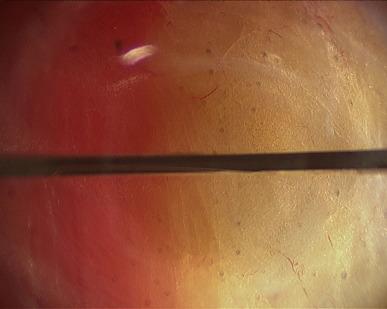 Figure 38.1, View through the visiport left of the linea alba and after the anterior rectus fascia has been horizontally incised.