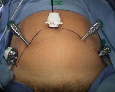 Figure 38.3, Port configuration for extraperitoneal robotic-assisted radical prostatectomy.