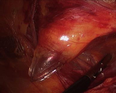 Figure 38.5, The spermatic cord is being held down as the assistant port is being placed caudal and superior to the peritoneal lining in the right lower quadrant.