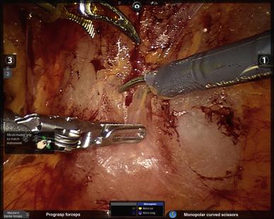 Figure 38.6, The space of retzius as it appears after removal of the insufflation balloon, port placement, and insertion of robotic instruments.