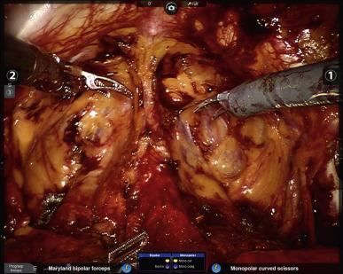 Figure 38.7, The same space after areolar tissue has been cleared away, but prior to defatting.