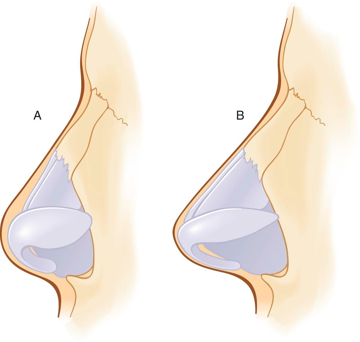 Figure 27-1, Schematic comparison of nasal skin thickness in the thick-skinned platyrrhine nose ( A ) and in the mesorrhine nose with intermediate skin thickness ( B ). In both types of nasal morphology, skin is thickest at the nasion and supratip. However, in the platyrrhine nose ( A ), the cartilage framework is typically weak and underprojected, with broad, soft alar cartilages that are covered by a comparatively thick skin–soft tissue envelope. In contrast, the mesorrhine nose ( B ) is characterized by a strong, well-projected skeletal framework and a more delicate skin–soft tissue envelope, giving rise to a more attractive outer contour.