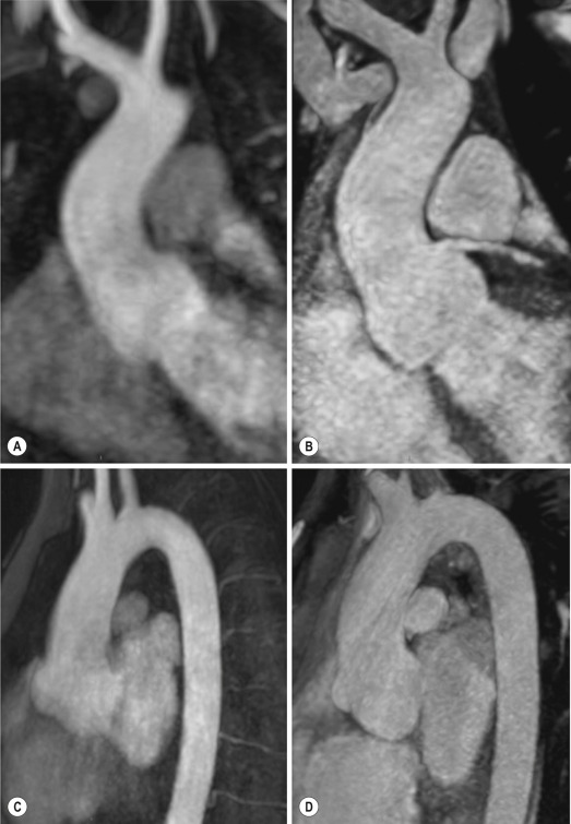 Fig. 17.1, Magnetic resonance angiography (MRA) coronal (A and B) and sagittal (C and D) oblique multiplanar reconstruction of ascending aorta. (A and C) Contrast-enhanced MRA. (B and D) Native three-dimensional (3D) steady-state free-precession (SSFP) MRA with ECG and navigator gating (free breathing). Note superior image quality of 3D SSFP MRA technique in the same patient.