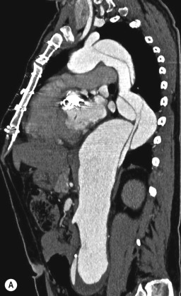 Fig. 17.11, Multidetector computed tomography sagittal oblique multiplanar reformation images of a type B dissection (A) and an aneurysm with mural thrombus (B). Note the spiralling shape of the intimal flap and the true lumen in the descending aorta, while the thrombus maintains its relationship with the posterior aortic wall. The internal border of the thrombus is irregular, different from aortic dissection, and the calcification is on the external border.