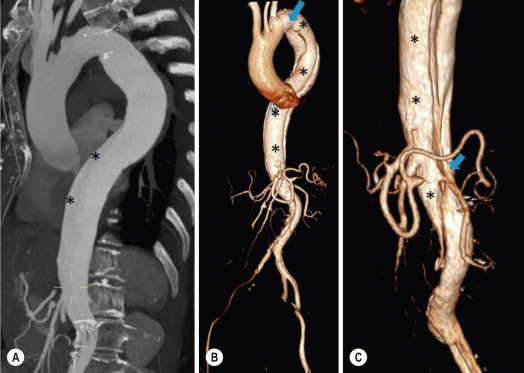 Fig. 17.12, Multidetector computed tomography maximum intensity projection (MIP) (A) and volume-rendering (VR) reconstructions (B and C) of type B aortic dissection. Both reconstruction techniques give panoramic views of the thoracoabdominal aorta and many anatomical details of the dissection. However, MIP images may partially obscure the intimal flap, the true lumen (*) and the intimal tears (A), while VR images provide optimal visualisation of entry and re-entry tears (arrows,) as well as the true lumen and intimal flap (*), with a comprehensive evaluation of the aortic disease.