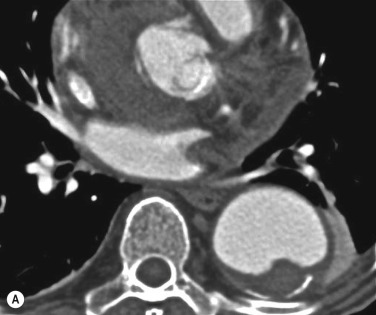 Fig. 17.13, Computed tomography cross-sectional images of a thrombosed aneurysm (A) and an intramural haematoma (IMH) (B) of descending thoracic aorta. Note that IMH has a typical semilunar shape with smooth borders, while the thrombus margins are irregular.