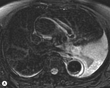 Fig. 17.14, Magnetic Resonance Black-Blood Fast Spin-Echo Images of an Intramural Haematoma (IMH) 8 Days After Symptoms Onset.