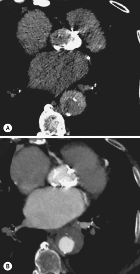 Fig. 17.15, Typical Computed Tomography (CT) Appearance of an Acute Intramural Haematoma.