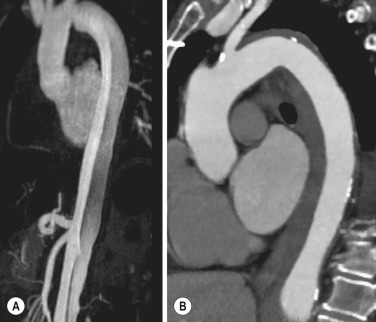 Fig. 17.16, Differentiation Between False Lumen Thrombosis and Intramural Haematoma (IMH).