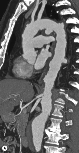 Fig. 17.17, Penetrating Atherosclerotic Ulcers.