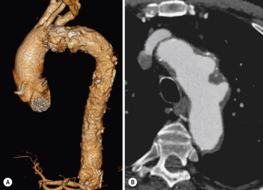 Fig. 17.18, Penetrating Ulcers of the Aortic Arch.