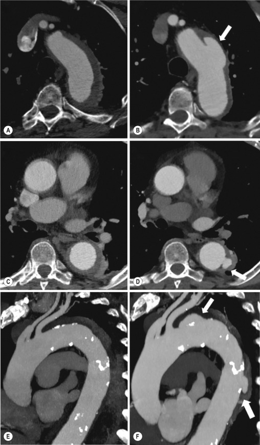 Fig. 17.19, Multidetector computed tomography multiplanar reformation axial (A to D) and sagittal oblique (E and F) images of an intramural haematoma of the descending thoracic aorta (A, C and E). After 8 days from symptom onset the intramural haematoma has partially reabsorbed but, at the level of the isthmic and midthoracic descending aorta, has evolved into a penetrating ulcer ( arrows in B, D and F).