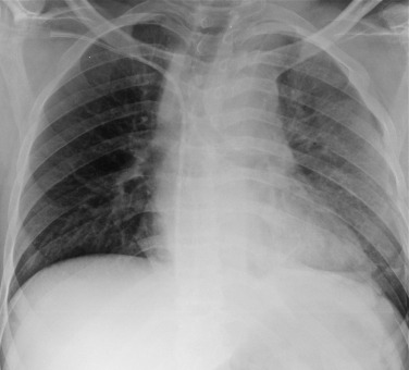 Fig. 17.20, Supine Chest Radiograph of a Patient Involved in a Road Traffic Accident Demonstrates Signs of Traumatic Aortic Injury.