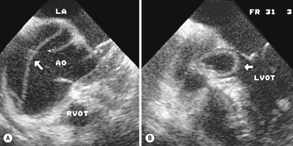 Fig. 17.2, Transoesophageal Echocardiogram of a Type A Dissection.