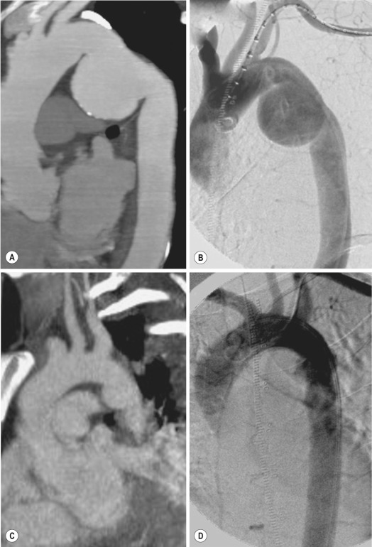 Fig. 17.21, Computed tomography (A and C) and angiographic (B and D) findings of a traumatic aortic injury. A large pseudoaneurysm (chronic traumatic lesion) is evident at the aortic concavity just distal to the arch (A and B). A small pseudoaneurysm of an acute traumatic aortic injury (C and D) is seen as an irregularity of the aortic contour.