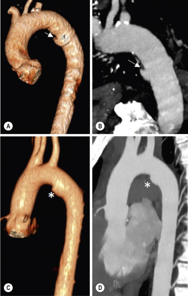 Fig. 17.22, Difference between a traumatic pseudoaneurysm (A and B) and a normal ductus diverticulum (C and D). The pseudoaneurysm is asymmetric and has an acute proximal margin with the normal aorta (arrows) . The ductus diverticulum has a smooth symmetrical contour with obtuse margins at its junction with the ‘normal’ aorta (*) .