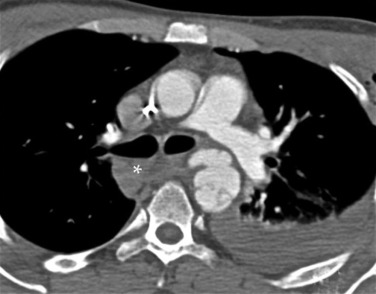 Fig. 17.23, Axial Computed Tomography Image of an Acute Traumatic Aortic Injury.