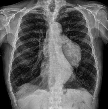 Fig. 17.24, Chest X-Ray Showing a Large Descending Thoracic Aortic Aneurysm Simulating a Mediastinal Tumour.