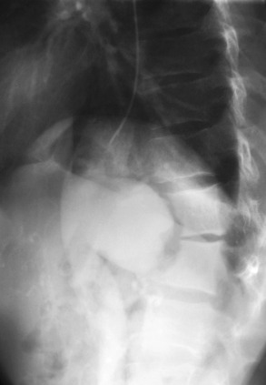 Fig. 17.25, Lateral aortogram in a patient with severe midback pain and lumbar spine demonstrates anterior erosion of the lower thoracic vertebral bodies. The angiogram demonstrates that this has been caused by a pulsatile thoracoabdominal aortic aneurysm.