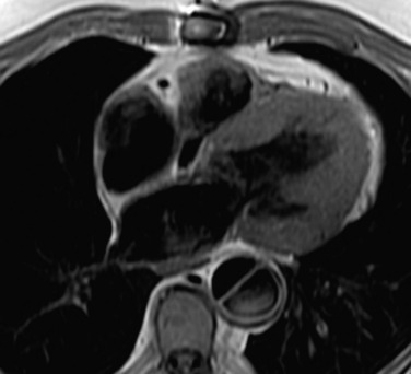 Fig. 17.3, Axial Black-Blood Fast Spin-Echo Magnetic Resonance Image of Chronic Type B Aortic Dissection.