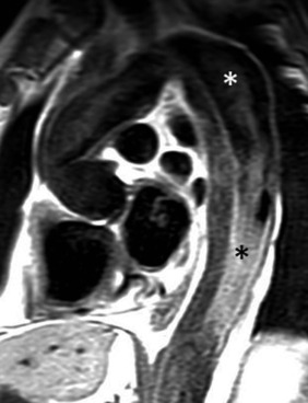 Fig. 17.4, Sagittal Oblique Black-Blood Fast Spin-Echo Magnetic Resonance Image of Chronic Type B Aortic Dissection.