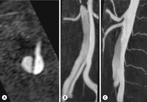 Fig. 17.5, Magnetic resonance angiography of type B aortic dissection (A to C). Images display clearly the relationships of true and false lumen with coeliac trunk (A and C), superior mesenteric artery (C) and right and left arteries (B). Note that true lumen is the smaller and best enhanced one. The right renal artery arises from the false lumen, while other splanchnic vessels arise from the true one.