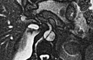 Fig. 17.6, Axial Steady-State Free-Precession (SSFP) Magnetic Resonance Image of Type B Dissection at the Level of the Abdominal Aorta.