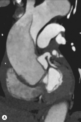 Fig. 17.7, Computed Tomography Images With Cardiac Gating of a Type A Aortic Dissection.