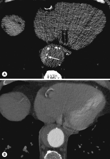 Fig. 17.8, Axial computed tomography (CT) before (A) and after intravenous contrast medium (B) CT image of the descending thoracic aorta. The mural calcification is displaced inside the lumen (arrow) and the presence of a bright crescent shape (*) give the suspicion of an intramural haematoma, confirmed after enhancement.