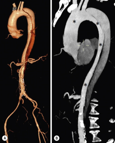 Fig. 17.9, Multidetector Computed Tomography Volume-Rendering (A) and Maximum Intensity Projection Image (B) of a Chronic Type B Aortic Dissection.