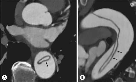 Fig. 17.10, Axial (A) and multiplanar reformation sagittal (B) computed tomography (CT) images of a type B aortic dissection. There is a circumferential intimal flap seen on CT as a hypodense linear image inside the aorta (arrows) . The true lumen is very small and completely surrounded by the false lumen (intimal intussusception).