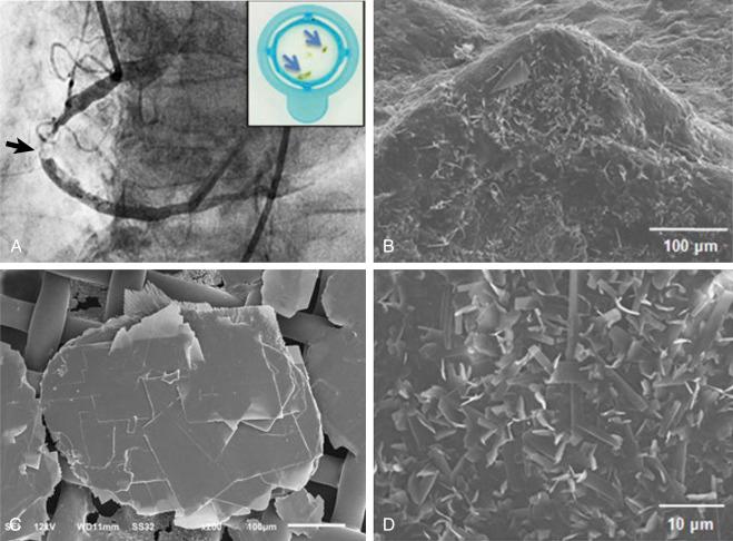 FIG. 28.1, Cholesterol crystals obtained from aspiration of an infarct-related coronary artery during acute myocardial infarction.