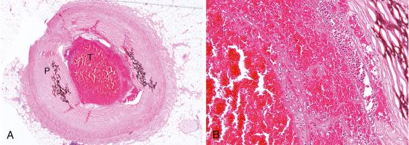 FIG. 28.2, High-power view of the right coronary artery.