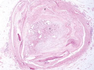 FIG. 28.3, Cross section of right coronary artery occluded by calcified, complicated atherosclerotic plaque (P) and organized thrombus ( T) (hematoxylin and eosin, magnification 2×).