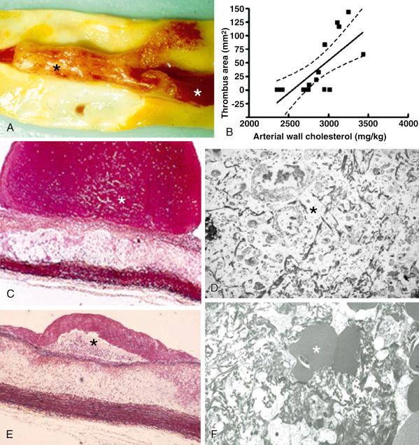 FIG. 28.5, Gross view of a predominantly white thrombus, as often seen in the atherosclerotic model of plaque disruption and thrombosis.