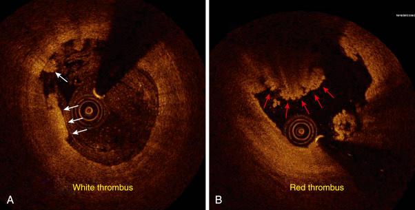 FIG. 28.6, Optical coherence tomography demonstrates white thrombus (A, arrows ) and red thrombus (B, arrows ).