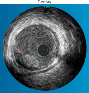 FIG. 28.7, Utilization of coronary intravascular ultrasound (IVUS) for thrombus detection.