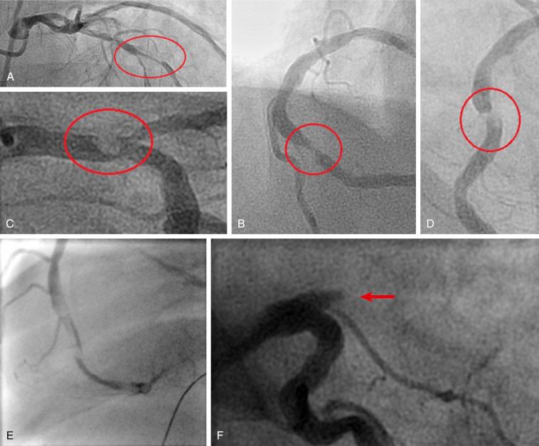 FIG. 28.8, Grades of thrombus as defined by the classic thrombolysis in myocardial infarction (TIMI) thrombus grading.