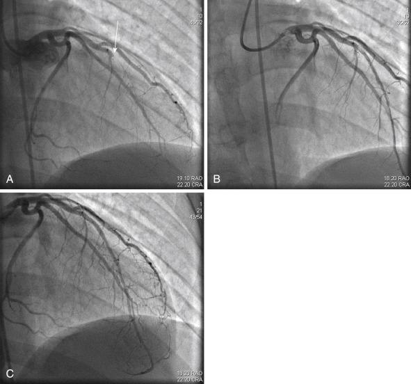 FIG. 28.9, Grade 5 thrombus.