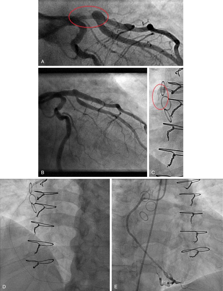 FIG. 28.10, (A) The new modification of the Thoraxcenter grade 5 thrombus. Restratification of the grade 5: with a guidewire and a small balloon, the thrombus was transformed to grade 2 (red circle) . Thus the initial thrombus corresponds to thrombus grade 5 type A. (B) Final percutaneous coronary interventions results after stenting of the target lesion, demonstrating marked patency of the vessel and no residual thrombus (final grade 0). (C) Thrombus grade 5 in the ostium-proximal portion of an old saphenous vein bypass graft in a patient with unstable angina and ischemia of the inferior lateral wall (red circle) . (D) Grade 5 stratification enabled in guidewire to cross the total thrombotic occlusion and be positioned distally, but antegrade flow was not restored. This corresponds to grade 5 type B. (E) Final angiography after application of excimer laser and stenting over the guidewire reveals adequate patency of the old graft with no residual thrombus.