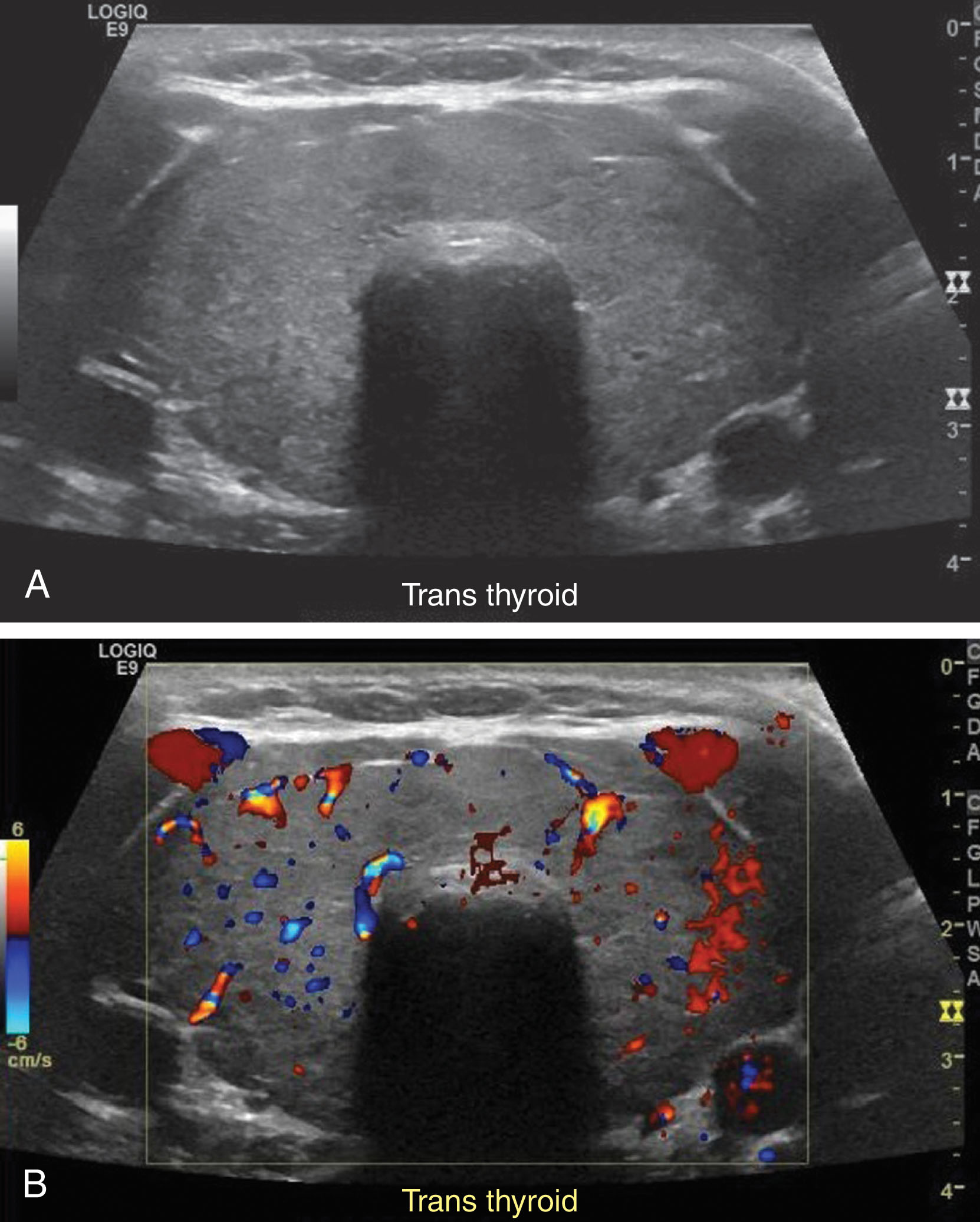 Fig. 22.11, (A) A patient with a goiter demonstrating diffusely enlarged thyroid gland. (B) Vascularity of the diffusely enlarged thyroid gland.