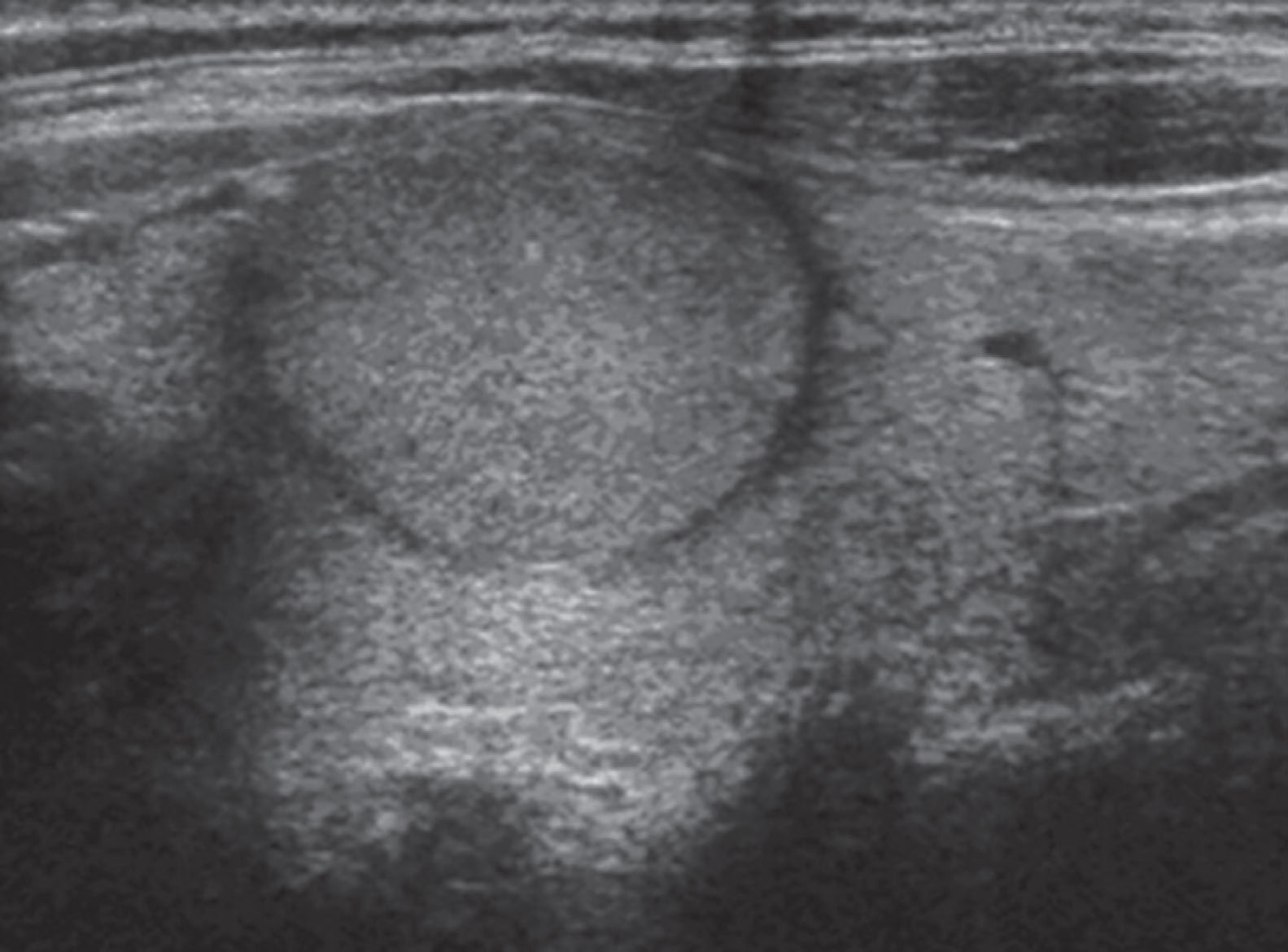 Fig. 22.13, Nodules may present as poorly circumscribed or well defined and encapsulated by a thin, peripheral hypoechoic halo due to surrounding compressed tissue and should be documented.