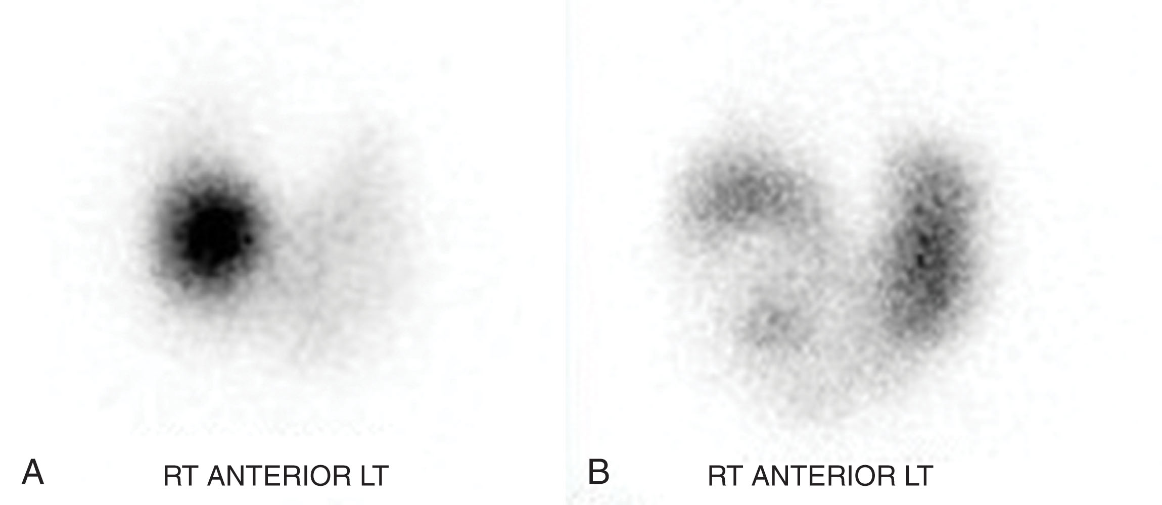 Fig. 22.2, (A) Scintigraphy of the thyroid gland demonstrating a “hot” nodule. (B) Scintigraphy of the thyroid demonstrating a “cold” nodule.