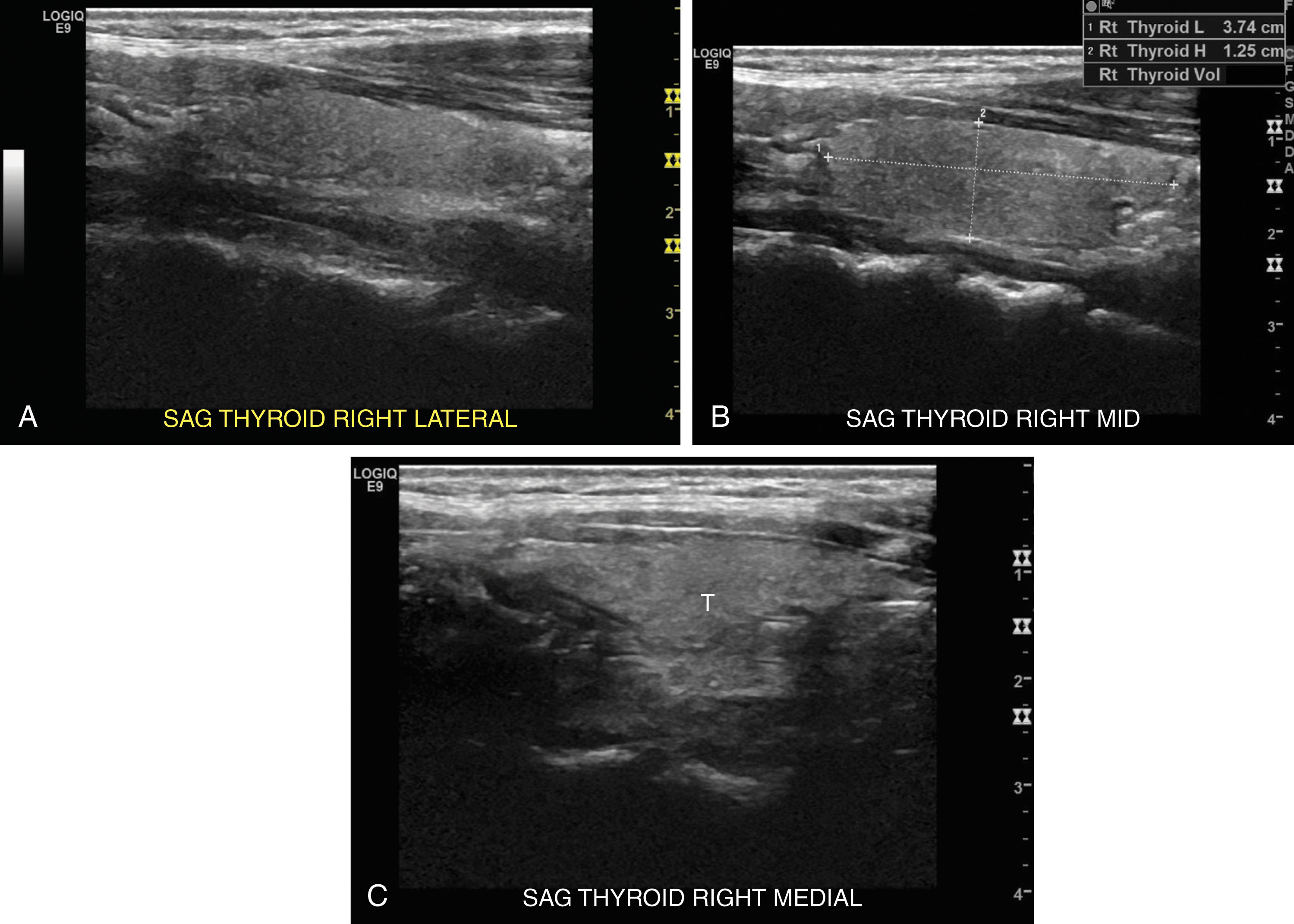 Fig. 22.4, Longitudinal images of the normal thyroid gland. (A) Long, lateral. (B) Long, mid. Measurement of the length and anteroposterior dimension of the gland. (C) Long, medial. T , Thyroid.