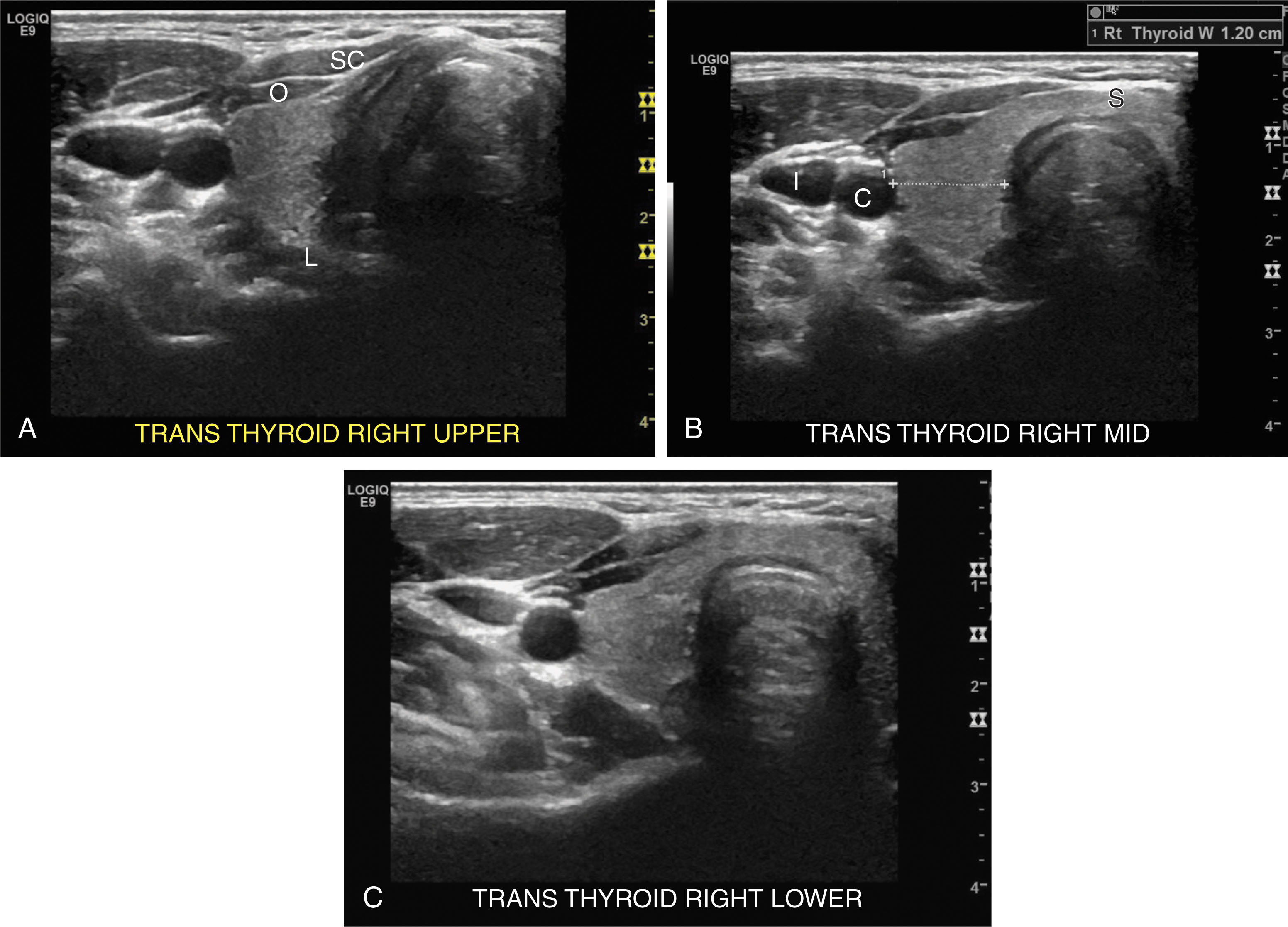 Fig. 22.5, Transverse images of the normal thyroid gland. (A) Trans, superior. (B) Trans, mid. Measurement of the width of the gland. (C) Trans, inferior. C , Carotid artery; I , internal jugular vein; L , longus colli muscle; O , omohyoid muscle; S , sternohyoid muscle; SC , sternocleidomastoid.