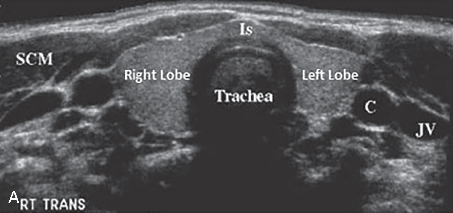 Fig. 22.7, Transverse and longitudinal survey of the isthmus is completed with images recorded and labeled. Transverse imaging landmarks include the trachea (Tr), common carotid artery (CCA), and internal jugular vein (IJV). The trachea is noted in the midline posterior to the isthmus (Is) with posterior shadowing. The common carotid artery is a circular, pulsatile structure directly lateral and adjacent to the gland. The oval-shaped internal jugular vein lies lateral to the common carotid artery. C , Carotid; JV , jugular vein.