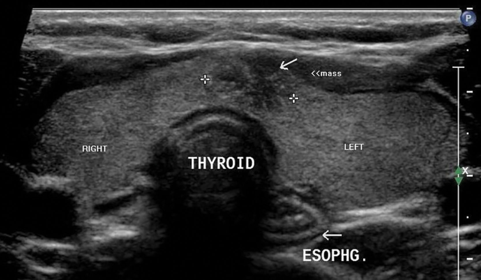 Fig. 22.9, The esophagus is adjacent to the trachea with a hypoechoic rim surrounding an echogenic center more commonly visualized slightly to the left of the midline, next to the trachea with peristalsis noted in real time with patient swallowing.